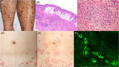 A case of immunoglobulin A vasculitis presenting with annular erythema